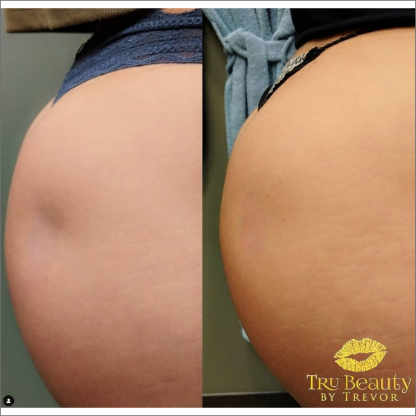 Trubeautybytrevor_Gallery_BOOTY_Before_and_After_Image_One_IN_HENDERSON_NV