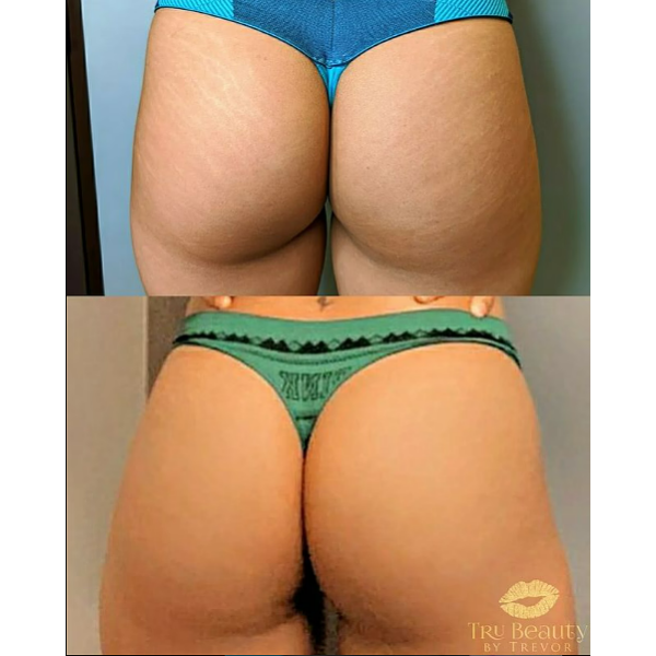 Trubeautybytrevor_Gallery_BOOTY_Before_and_After_Image_Three_IN_HENDERSON_NV