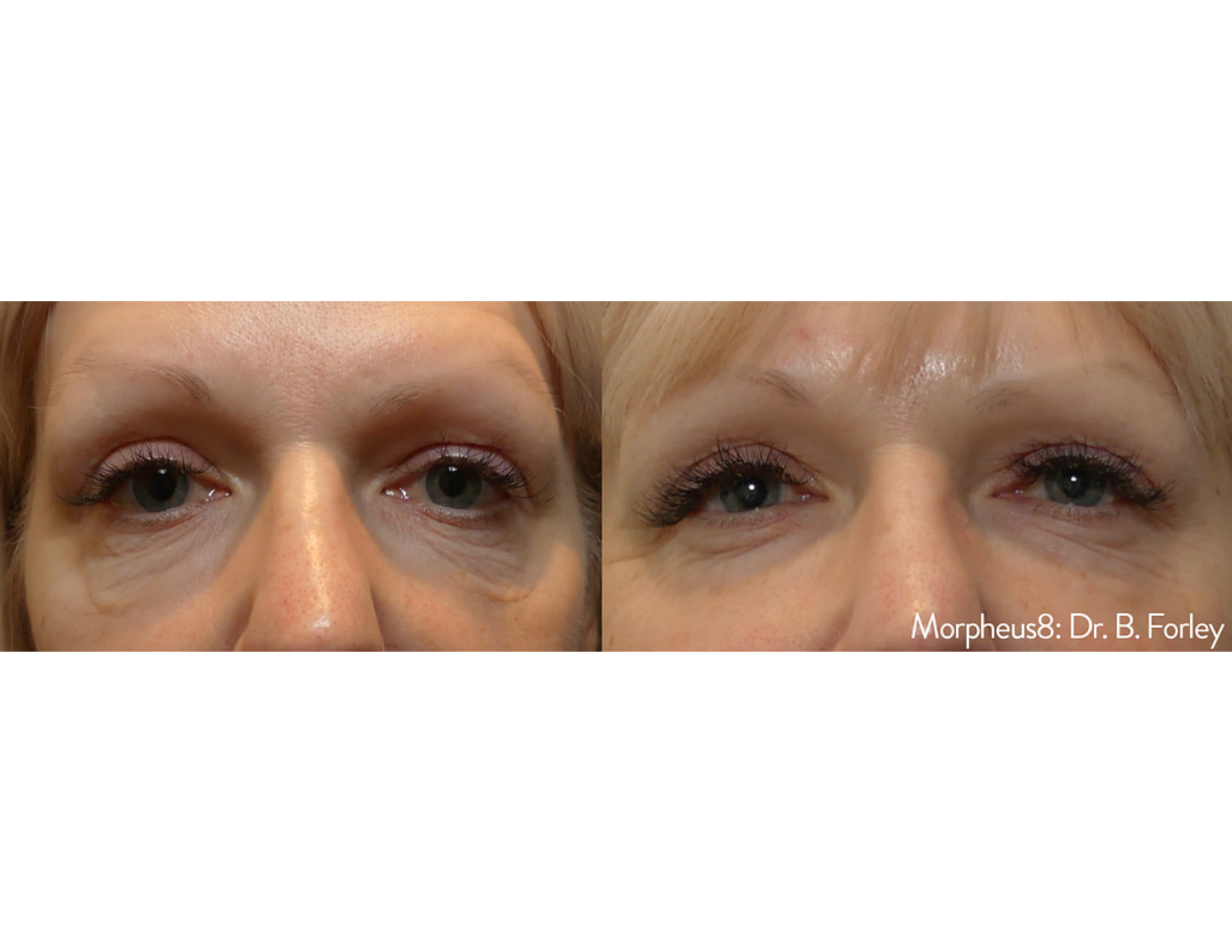 Trubeautybytrevor_Gallery_Image_MORPHEUS_Before_and_After_One_IN_HENDERSON_NV