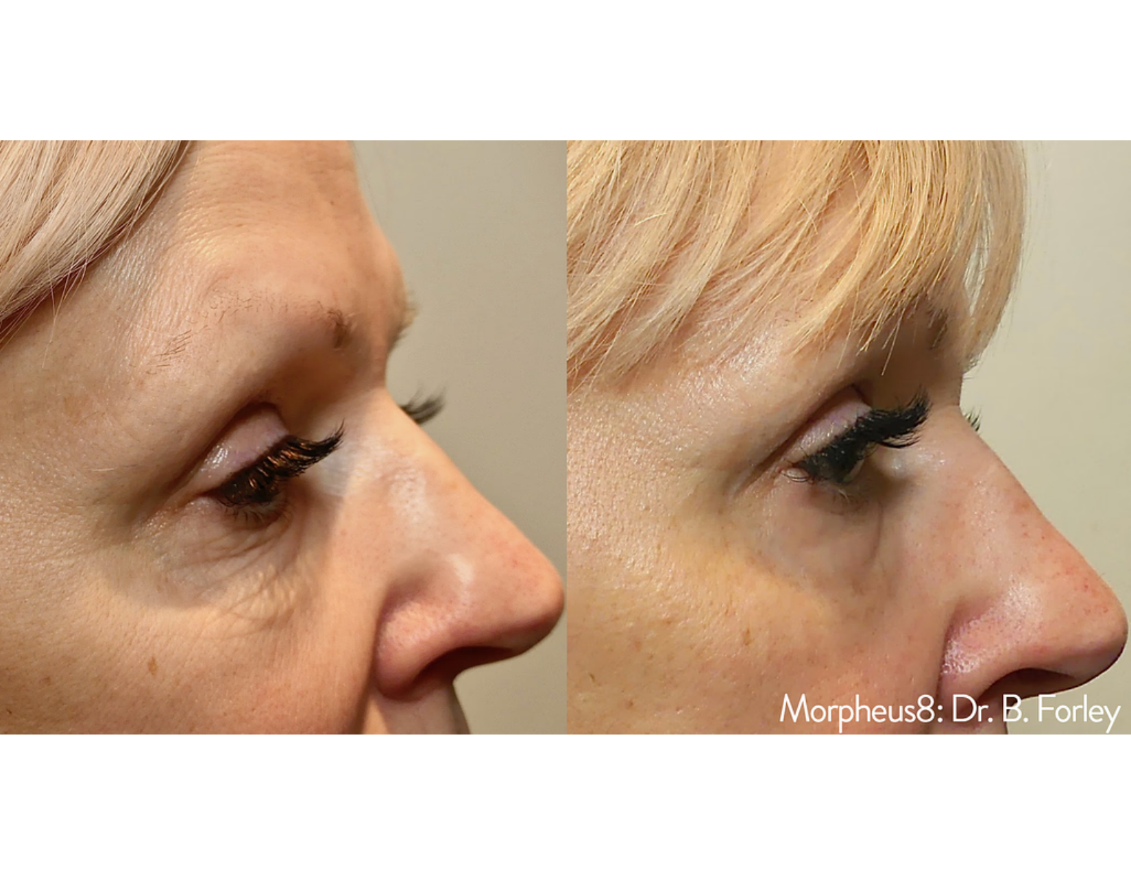 Trubeautybytrevor_Gallery_Image_MORPHEUS_Before_and_After_Three_IN_HENDERSON_NV