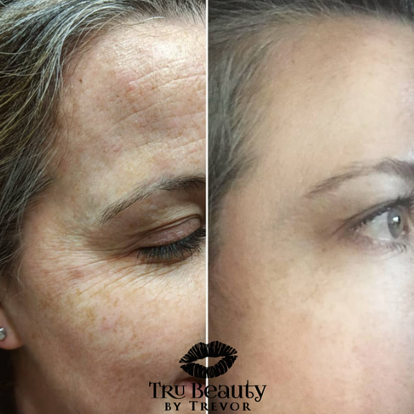 Trubeautybytrevor_Gallery_Image_NEUROTOXINS_Before_and_After_Five_IN_HENDERSON_NV