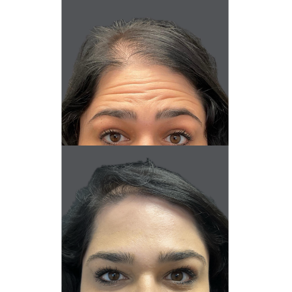 Trubeautybytrevor_Gallery_Image_NEUROTOXINS_Before_and_After_One_IN_HENDERSON_NV