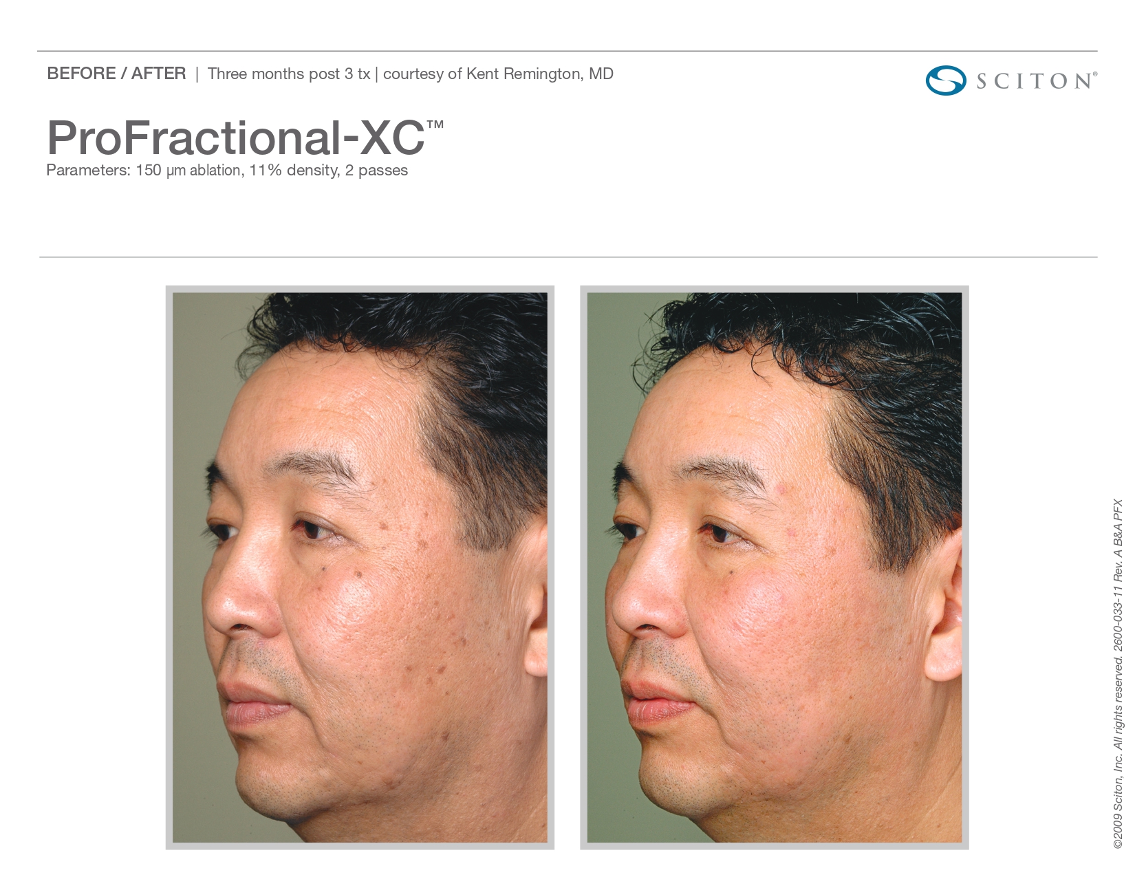Trubeautybytrevor_Gallery_Image_PROFRACTIONAL_Before_and_After_Nine_IN_HENDERSON_NV