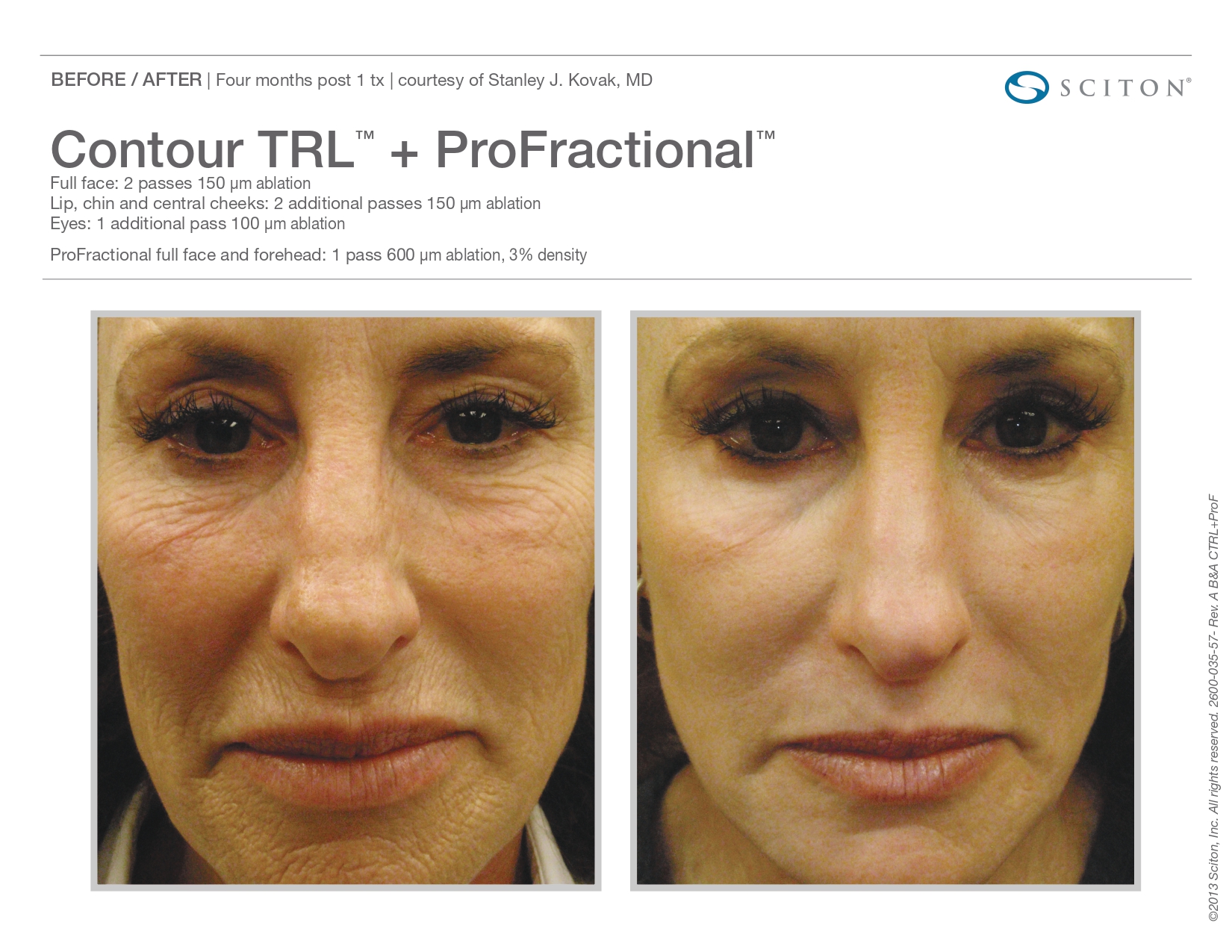 Trubeautybytrevor_Gallery_Image_PROFRACTIONAL_Before_and_After_One_IN_HENDERSON_NV