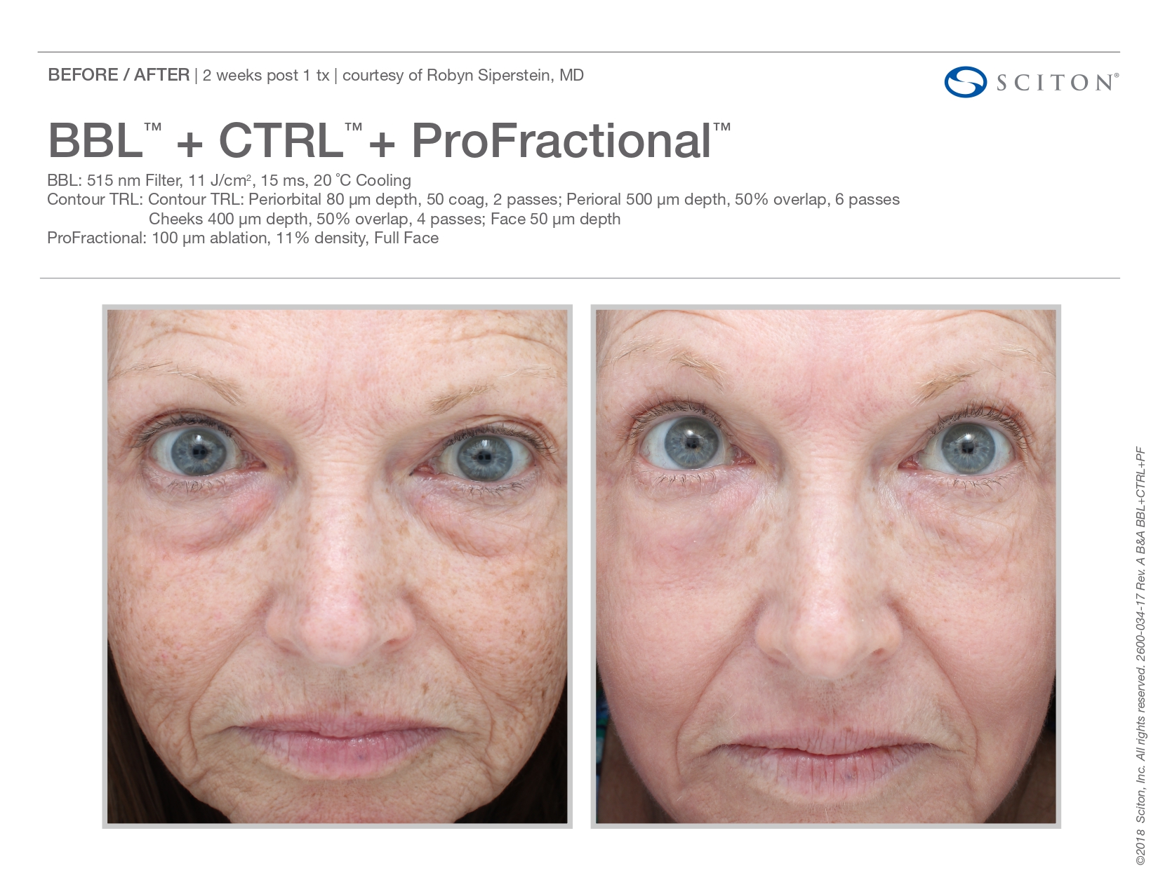 Trubeautybytrevor_Gallery_Image_PROFRACTIONAL_Before_and_After_Three_IN_HENDERSON_NV