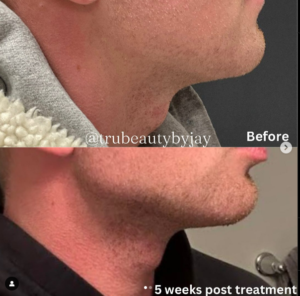Trubeautybytrevor_Gallery_JAWLINE_Before_and_After_Image_Four_IN_HENDERSON_NV