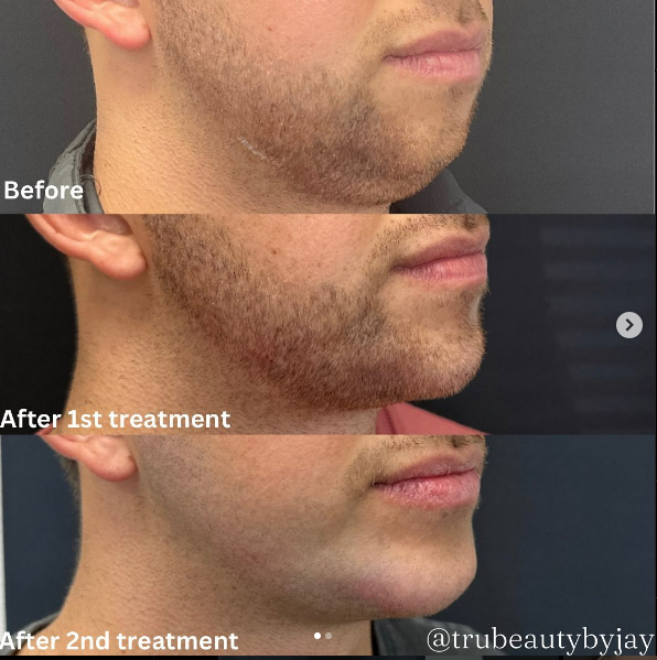 Trubeautybytrevor_Gallery_JAWLINE_Before_and_After_Image_One_IN_HENDERSON_NV