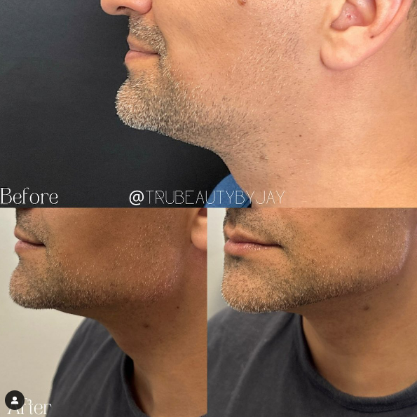 Trubeautybytrevor_Gallery_JAWLINE_Before_and_After_Image_Seven_IN_HENDERSON_NV