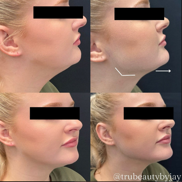 Trubeautybytrevor_Gallery_JAWLINE_Before_and_After_Image_Six_IN_HENDERSON_NV