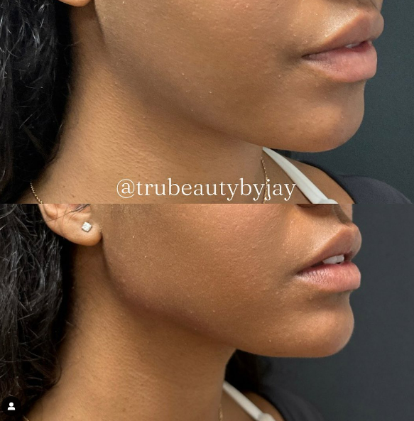 Trubeautybytrevor_Gallery_JAWLINE_Before_and_After_Image_Three_IN_HENDERSON_NV
