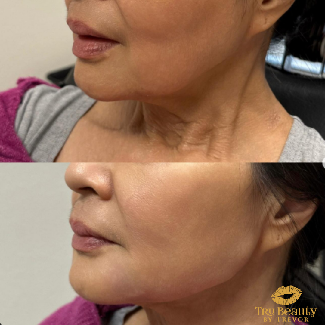 Trubeautybytrevor_Gallery_JAWLINE_Before_and_After_Image_Two_IN_HENDERSON_NV