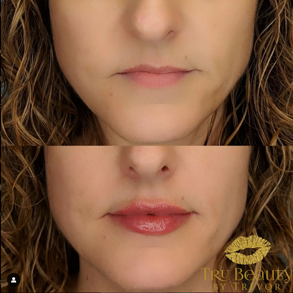 Trubeautybytrevor_Lips_Before_and_After_Gallery_Image_Eighteen_IN_HENDERSON_NV