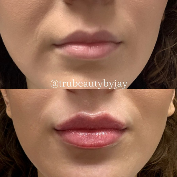 Trubeautybytrevor_Lips_Before_and_After_Gallery_Image_One_IN_HENDERSON_NV