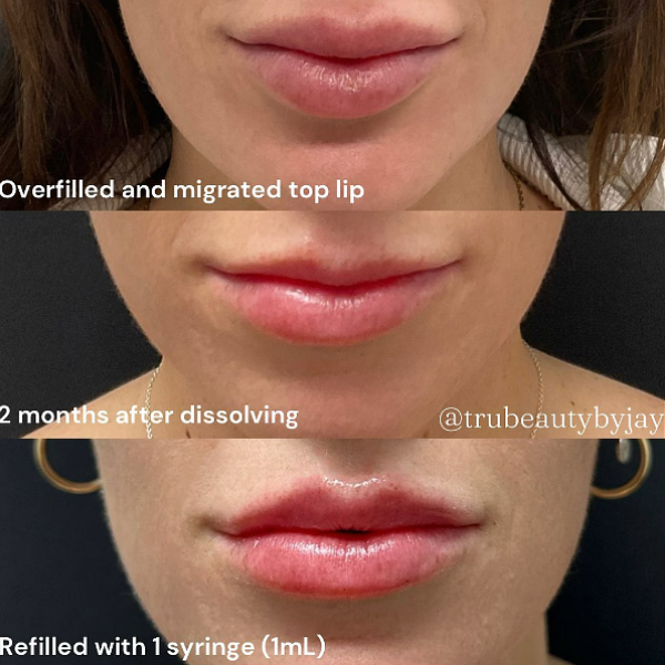 Trubeautybytrevor_Lips_Before_and_After_Gallery_Image_Seven_IN_HENDERSON_NV