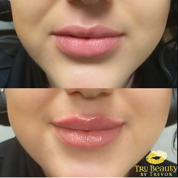 Trubeautybytrevor_Lips_Before_and_After_Gallery_Image_Seventeen_IN_HENDERSON_NV