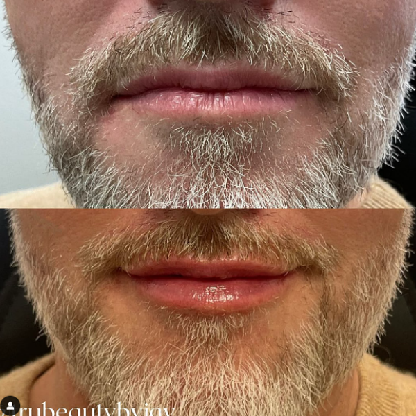 Trubeautybytrevor_Lips_Before_and_After_Gallery_Image_Ten_IN_HENDERSON_NV