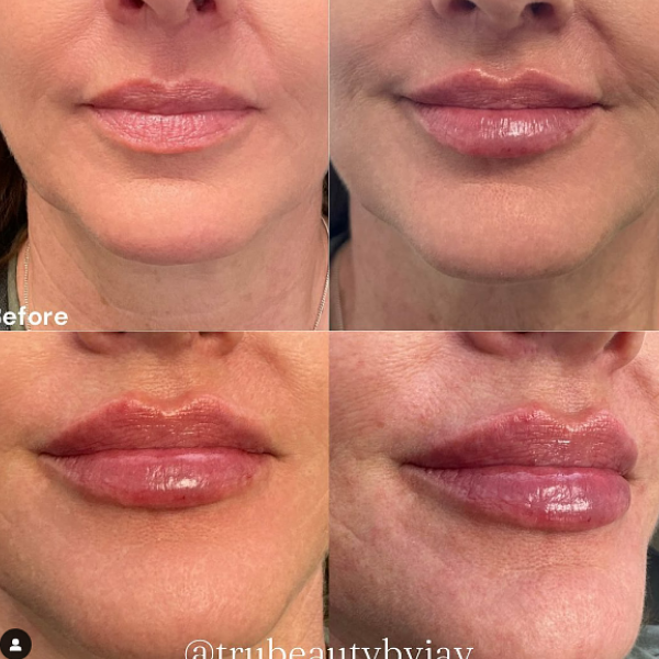 Trubeautybytrevor_Lips_Before_and_After_Gallery_Image_Three_IN_HENDERSON_NV