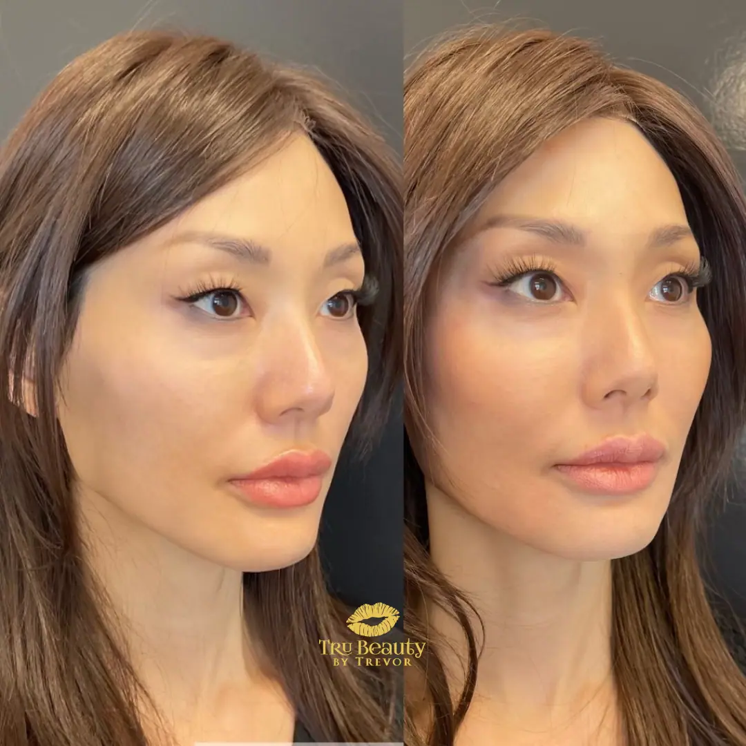 EZ Gel Filler | before and after | Tru Beauty By Trevor | Henderson, NV | Las Vegas, NV