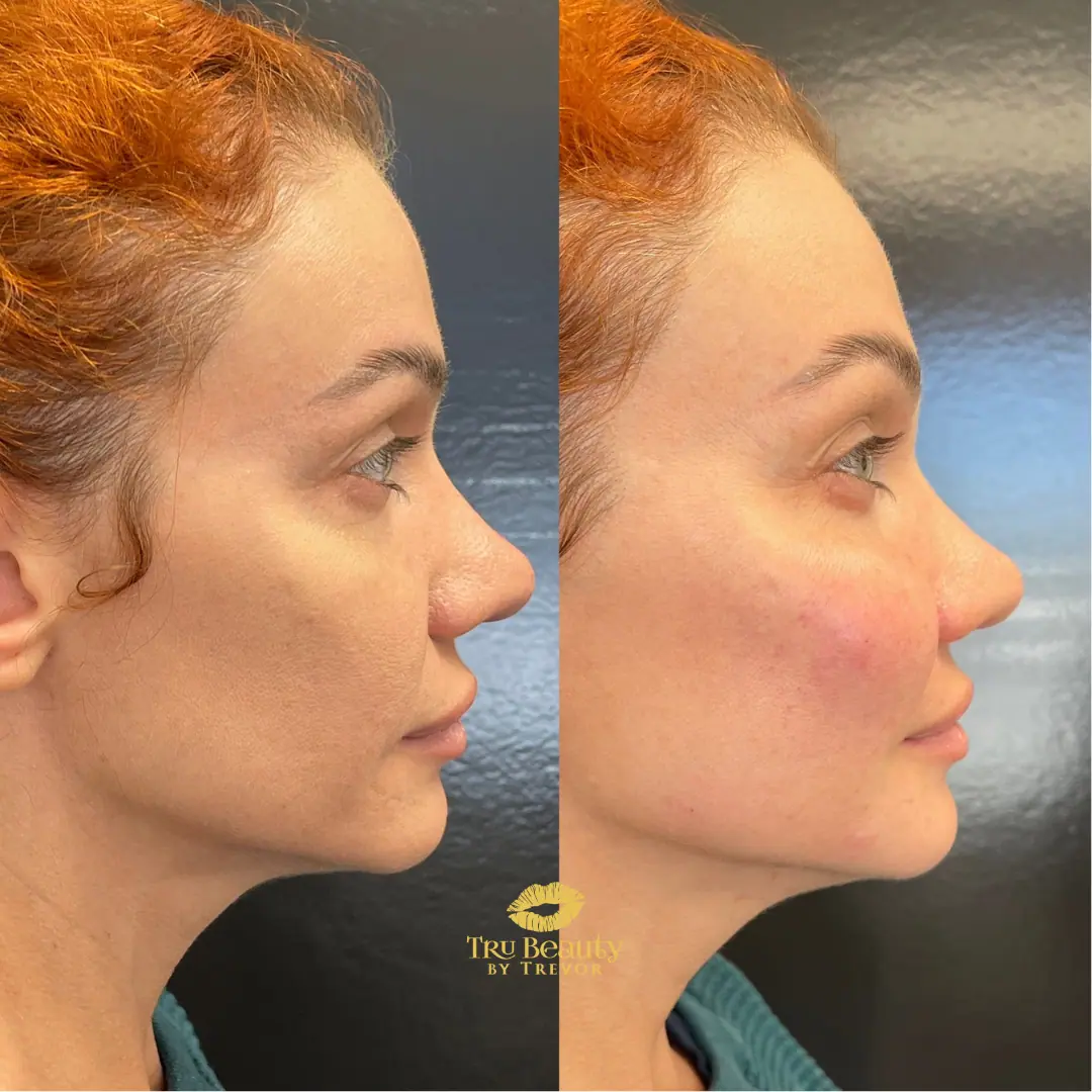 PRF Therapy | before and after | Tru Beauty By Trevor | Henderson, NV | Las Vegas, NV