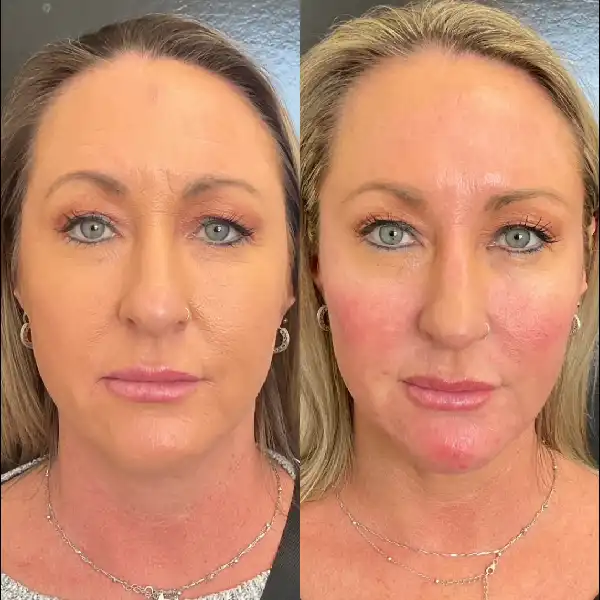 full face-n