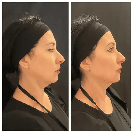 jawline 22