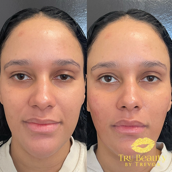 Facial Balancing 1