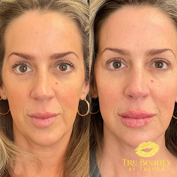 Facial Balancing 3