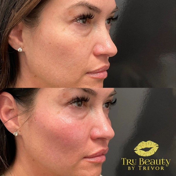 Facial Balancing 4