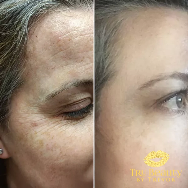 Trubeautybytrevor_Gallery_Image_NEUROTOXINS_Before_and_After_Five_IN_HENDERSON_NV