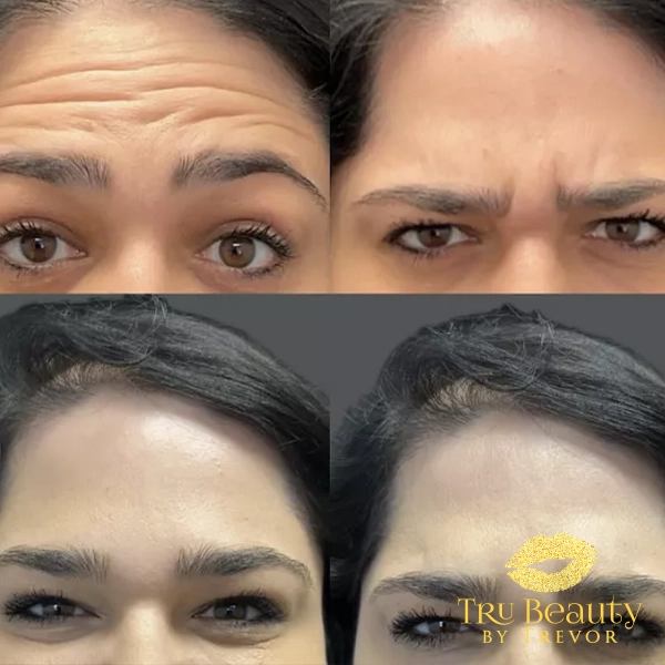 Trubeautybytrevor_Gallery_Image_NEUROTOXINS_Before_and_After_Four_IN_HENDERSON_NV