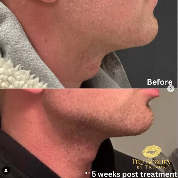 Trubeautybytrevor_Gallery_JAWLINE_Before_and_After_Image_Four_IN_HENDERSON_NV