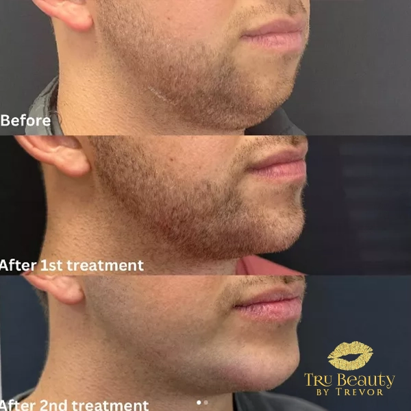 Trubeautybytrevor_Gallery_JAWLINE_Before_and_After_Image_One_IN_HENDERSON_NV (1)