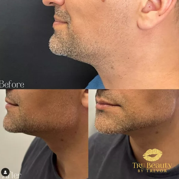 Trubeautybytrevor_Gallery_JAWLINE_Before_and_After_Image_Seven_IN_HENDERSON_NV