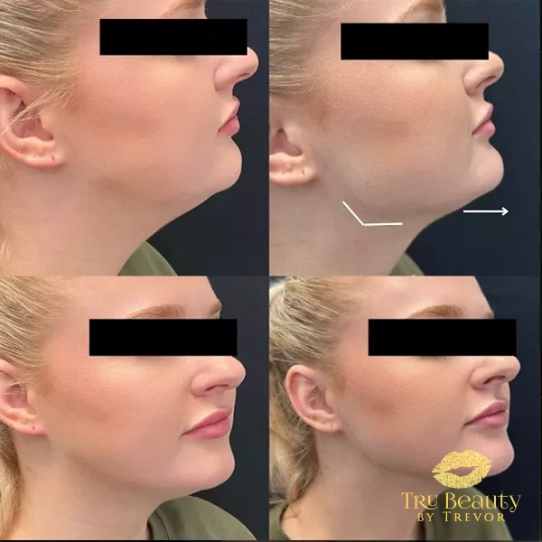 Trubeautybytrevor_Gallery_JAWLINE_Before_and_After_Image_Six_IN_HENDERSON_NV