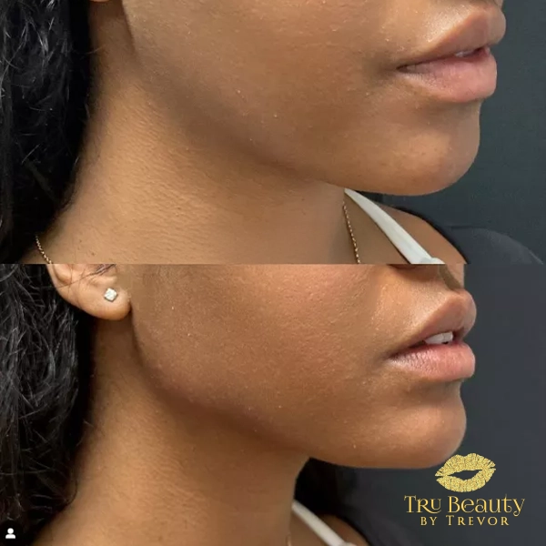 Trubeautybytrevor_Gallery_JAWLINE_Before_and_After_Image_Three_IN_HENDERSON_NV
