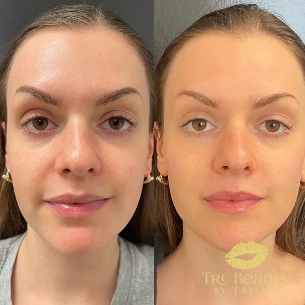 forteen-before-after