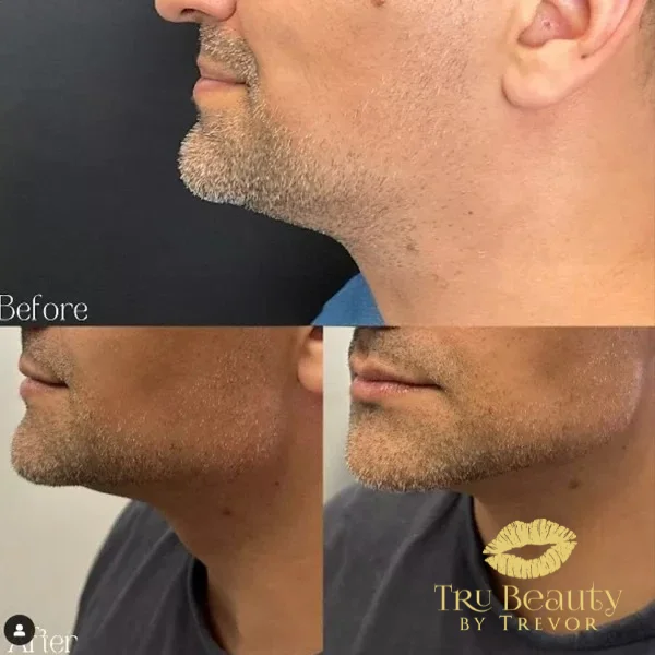 forty-before-after