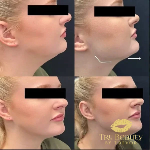 forty-one-before-after