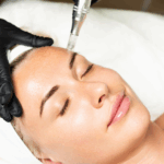 Microneedling at Tru Beauty By Trevor in Henderson, NV