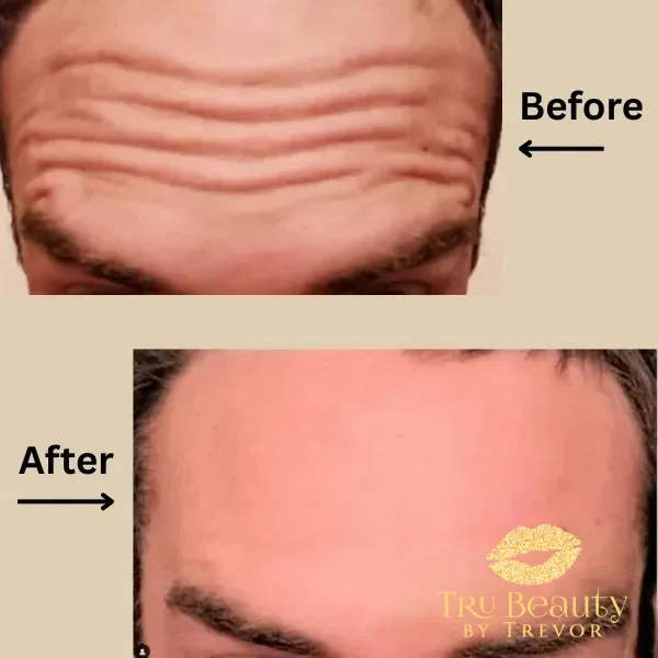 neurotoxin-new-bright-before-after