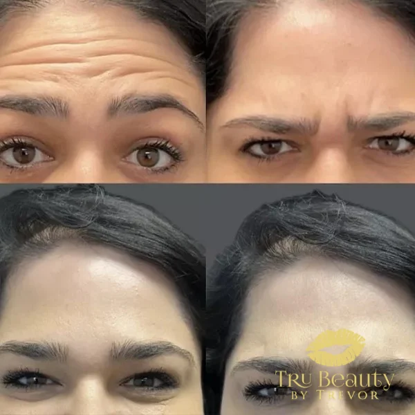 neurotoxin-three-before-after