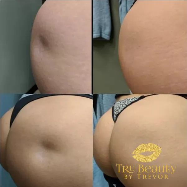 result-new-four-trubeauty