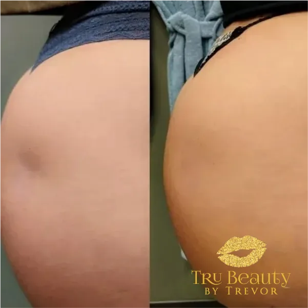 result-new-three-trubeauty
