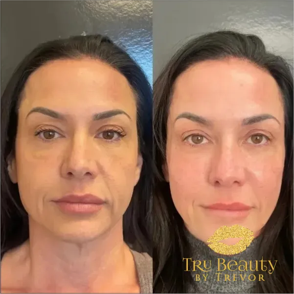 results-new-five-trubeauty