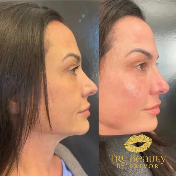 results-new-four-trubeauty