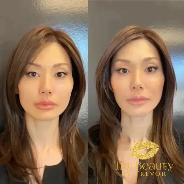 results-new-one-trubeauty