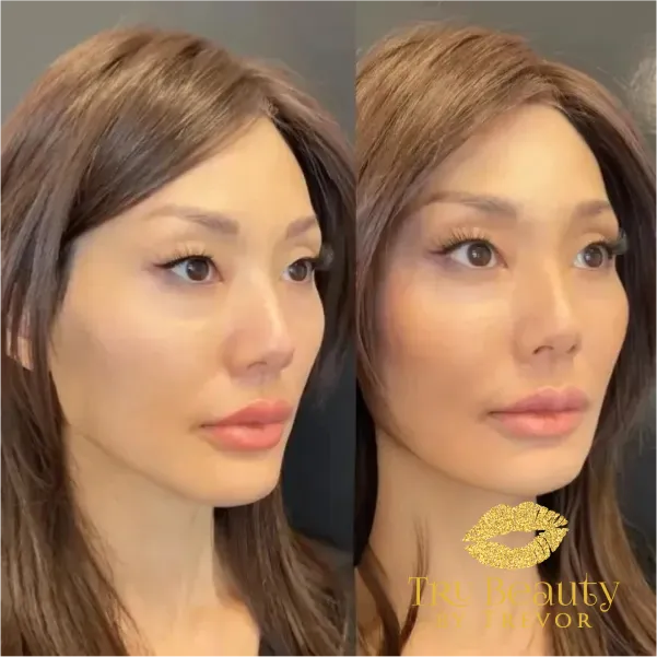 results-new-three-trubeauty