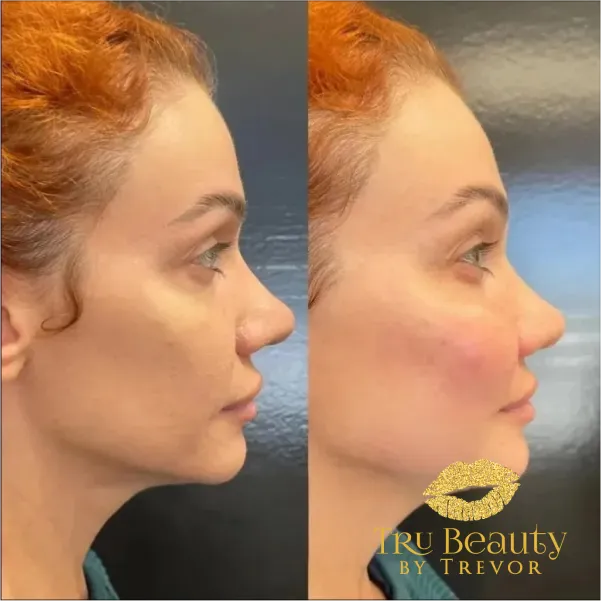 results-new-two-trubeauty