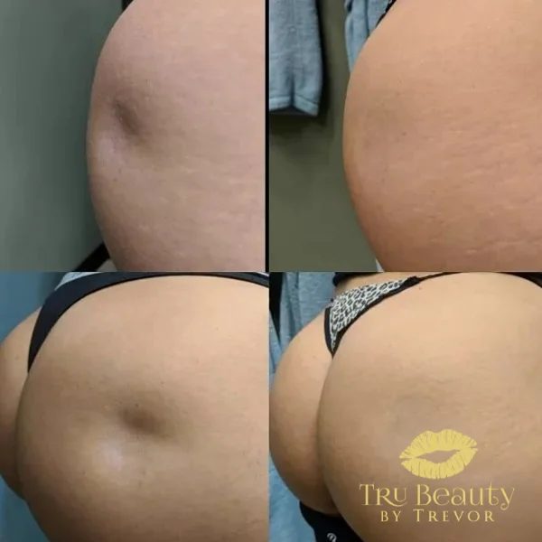 thirty-before-after