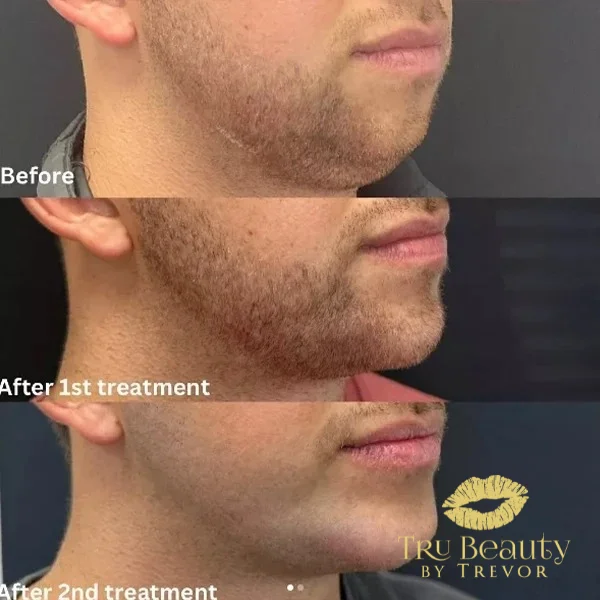 thirty-seven-before-after